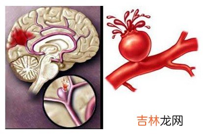 脑中风患者增四成患者若昏迷千万别摇晃