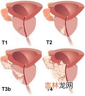 如何发现早期前列腺癌