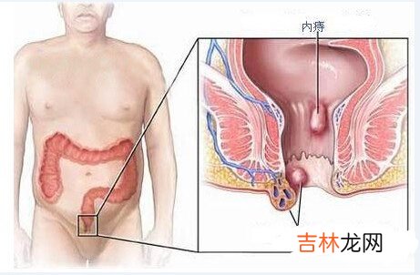 男性性生活过度频繁是引发痔疮的主要原因