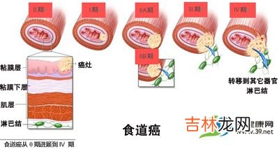 3人吃5年咸鱼患食道癌 致癌食物禁少量多吃