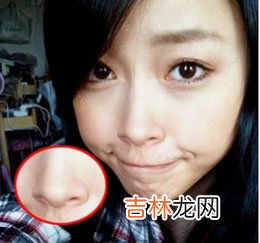 4种口口相传去黑头法 妙招还是毁肤