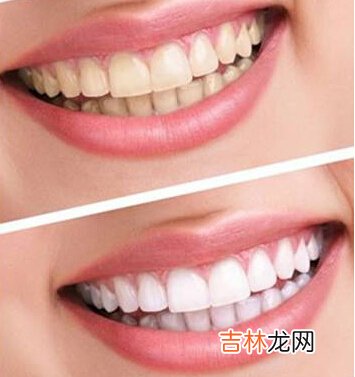 多种牙齿美白方法比较