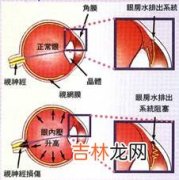 青光眼不可轻视