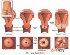 卫生部门提醒女性半年体检一次预防宫颈癌