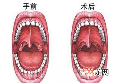 扁桃体该不该切