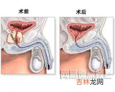 中国前列腺癌发病上升 专家提醒50岁男性应防治