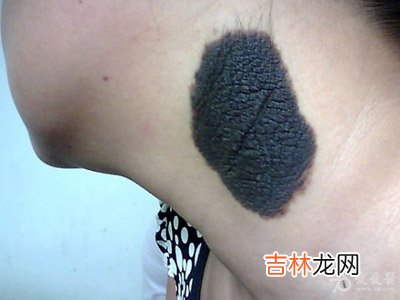 头部大毛痣瘤困扰20年 台男子术后获新生