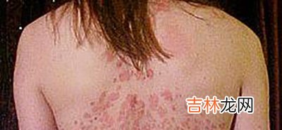 “银屑病”并不会传染 密切接触没有问题
