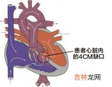 少女心脏长个“洞” 每分钟心跳比常人快十多次