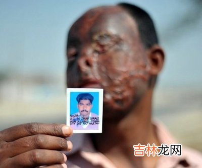 女子不满男友网上暴露生活隐私用硫酸将其毁容