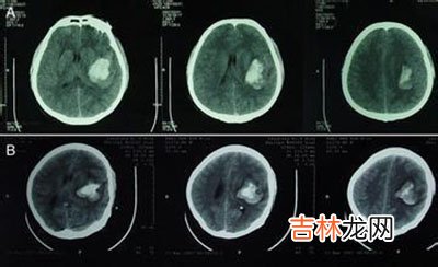 颅内瘀血13年 钙化成罕见“贝壳”