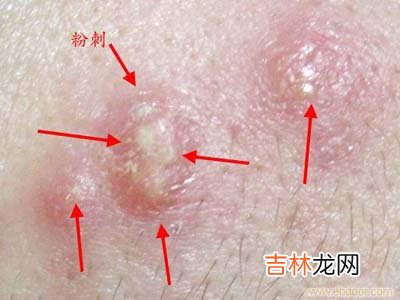 值得推荐的白头粉刺的治疗方法