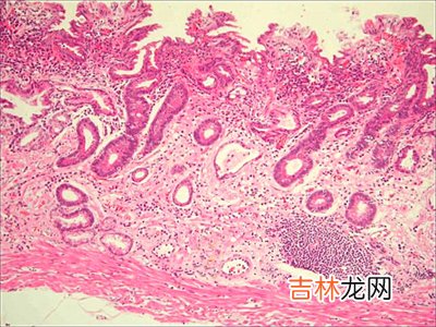 专家：缺硒会增加萎缩性胃炎癌变机会