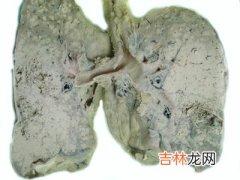 中国每十万人有35人患肺癌 7成诊断时已是晚期