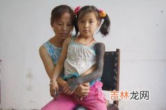 6岁女童与猫为伴染怪病 医治4年毫无结果