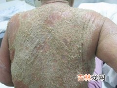 吃镇痛药全身水肿 男子双腿皮肤坏死险送命