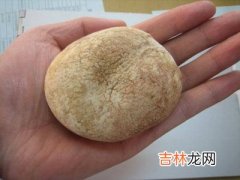 六旬男子胆内结石大过鸭蛋