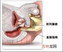 17岁中学生患前列腺炎 黄色网站是祸首