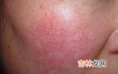 脸上有大量的红血丝怎么办