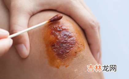 碘伏可以经常擦拭伤口吗