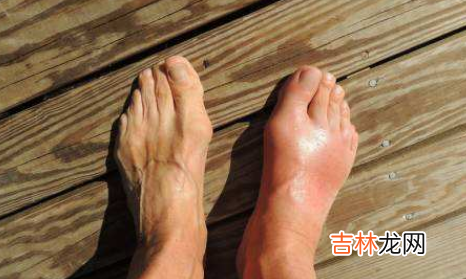 40岁得了痛风的人一般活多久