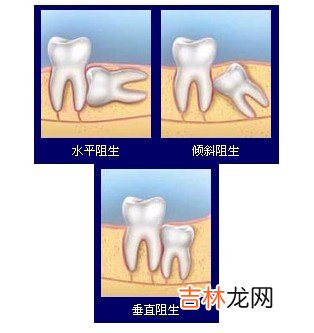 女孩子长智齿代表什么 智齿的长出意味着什么？