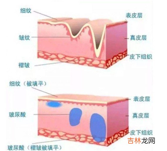 消除法令纹的方法 脸上的法令纹用什么方法可去