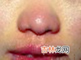 沙漠王子算命_眼圈发黑、红鼻子、口边痣、眼尾痣图解