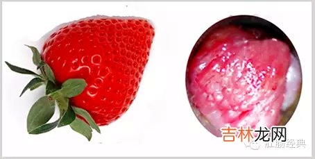 痔疮图片和正常图片的对比 痔疮图片和正常图片