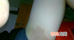 大腿内侧痒是什么病啊？最近痒得厉害总想抓