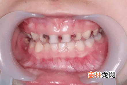 护牙小科普 | 0-18岁应该关注的口腔问题