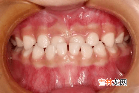 护牙小科普 | 0-18岁应该关注的口腔问题