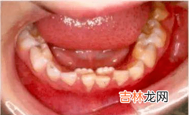 护牙小科普 | 0-18岁应该关注的口腔问题