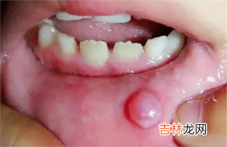 护牙小科普 | 0-18岁应该关注的口腔问题