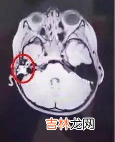 澳六岁男童看东西重影!母亲怀疑是视力问题,结果却惊闻噩耗!