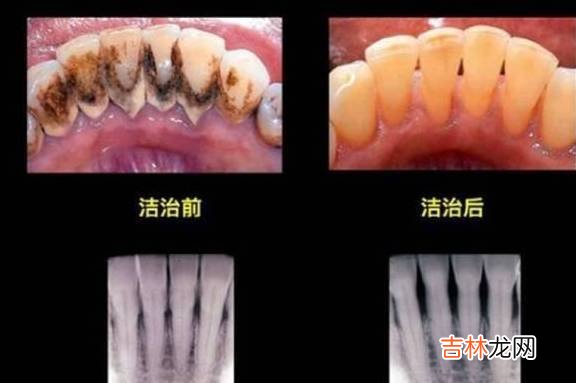 用牙线会让孩子牙缝变大？其实不用牙线才会让牙缝越来越大