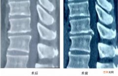 腰椎膨隆是什么意思  腰椎膨隆意思