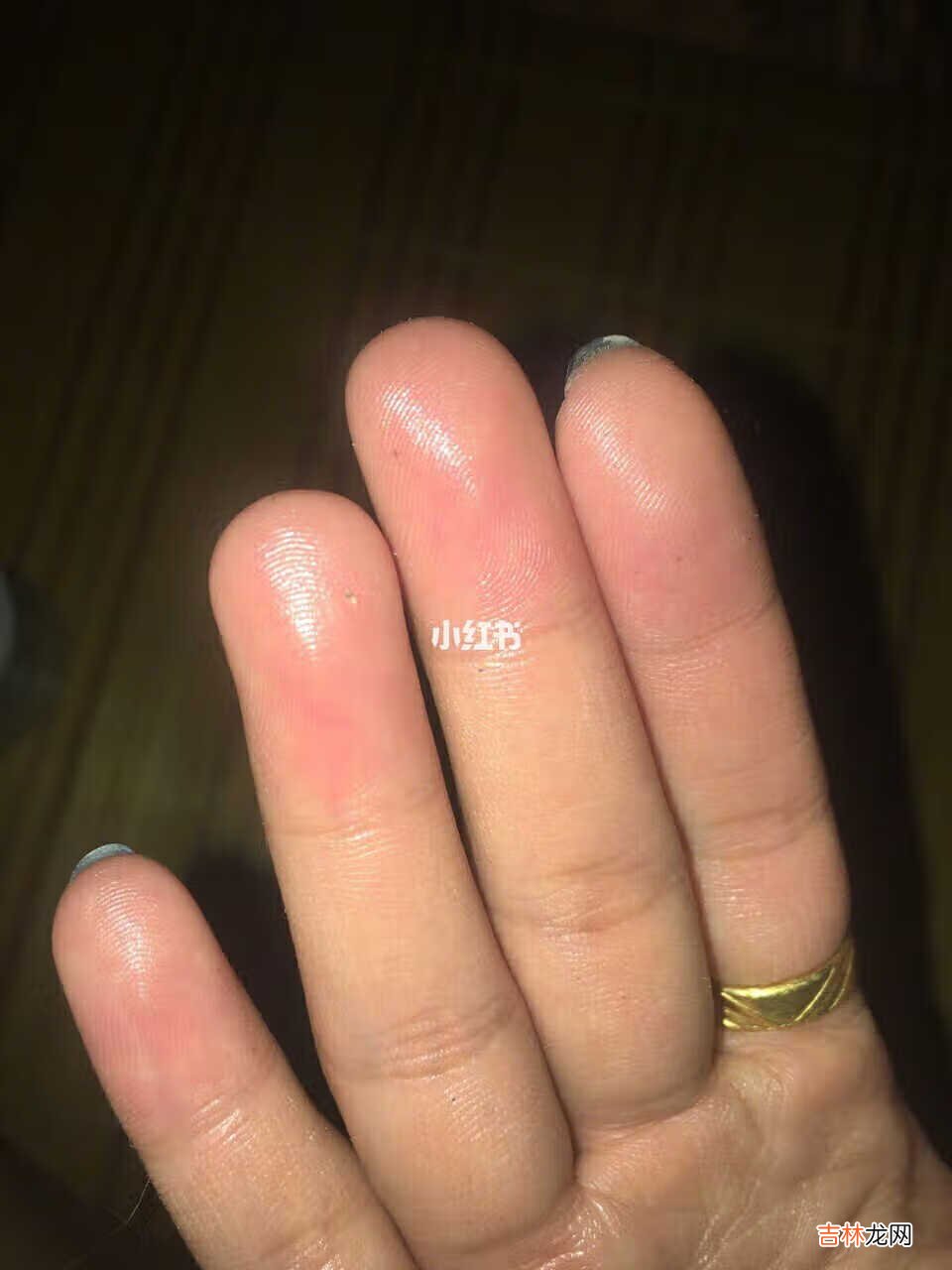 娥罗纳英H软膏,好用到不得不推。 娥罗纳英H软膏,真心好用,我的天啊