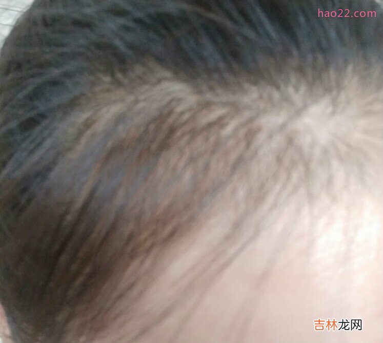 一直困扰我的脱发，丰添洗发水使用记录，一直更新 掉头发掉到怀疑自己得病
