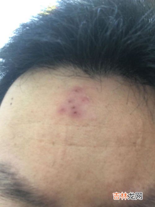 为什么痘痘会痛,脸上长一些红肿疼痛的大痘痘怎么回事