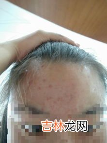为什么痘痘会痛,脸上长一些红肿疼痛的大痘痘怎么回事