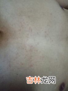 为什么痘痘会痛,脸上长一些红肿疼痛的大痘痘怎么回事