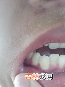 牙齿漂白多少钱一次,美白牙齿要多少钱一次
