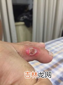 创可贴怎么撕下来不疼,创可贴贴了三天 结果粘到伤口上拿不下来了 怎么办