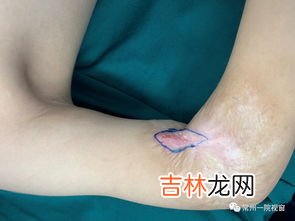 吃酱油会留疤吗,小时候常听父母说,受伤吃酱油会留疤,这是真的吗?
