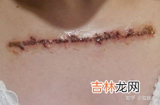 清洗纹身用什么药水,用什么药可以快速洗掉纹身？