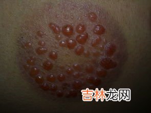 拔罐拔出水泡是怎么回事,拔罐拔出水泡来是怎么回事