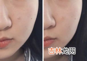 吃干脆面会长痘痘吗,为什么一吃方便面或者泡面,脸上就容易长痘痘?