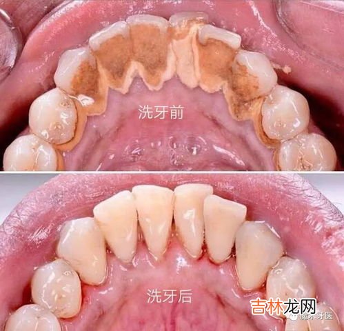 洁牙后注意事项有哪些,洗牙要注意哪些事项？