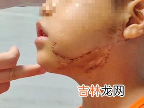 骨多邦有什么副作用,有什么妙方能治老年斑？